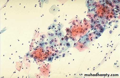 premalignant conditions of cervix