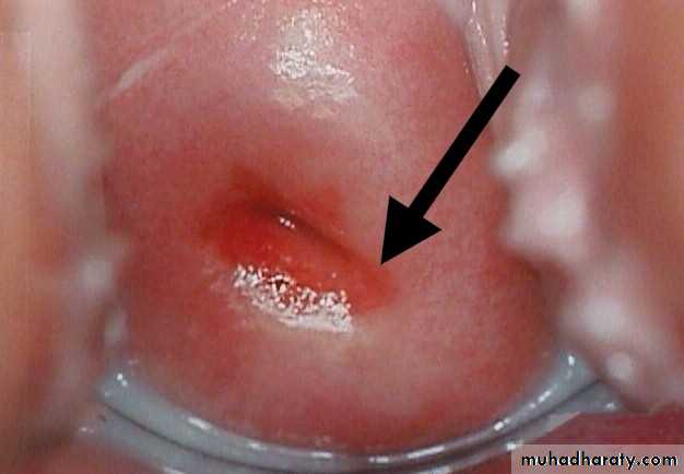 premalignant conditions of cervix