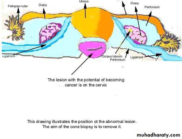 premalignant conditions of cervix