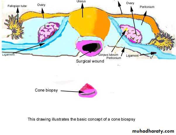 premalignant conditions of cervix