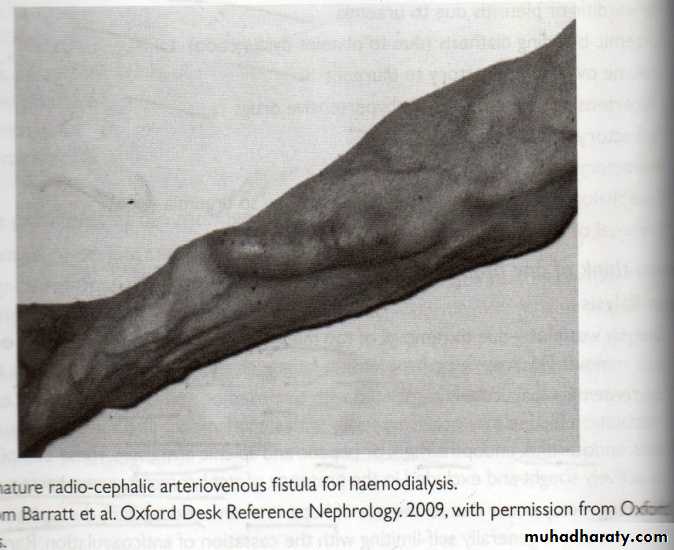 Transplantation