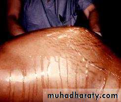 Peritoneum