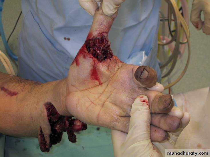 Wounds