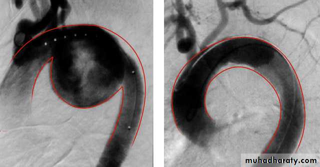Arterial Disorders