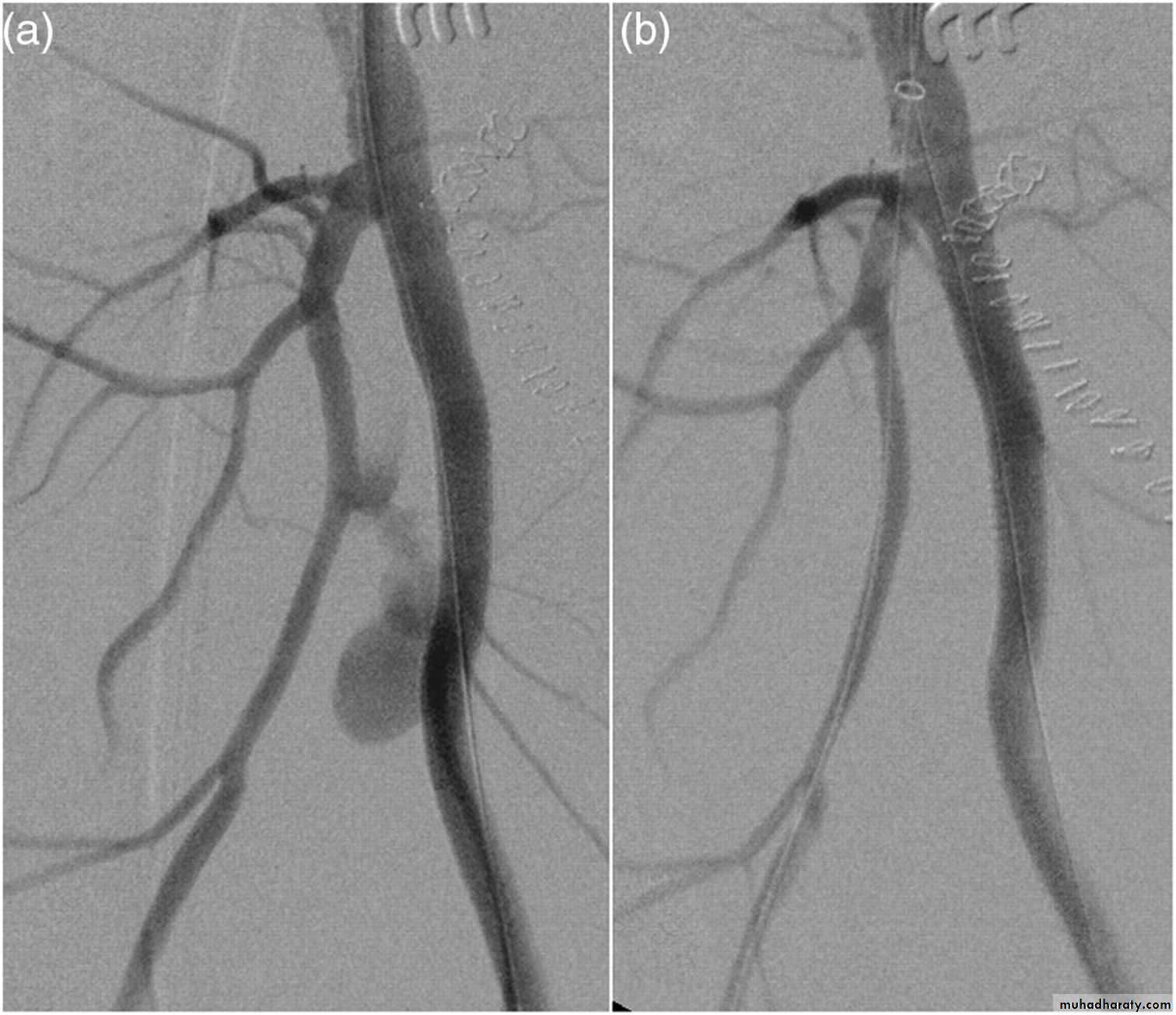 Arterial Disorders