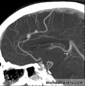 Arterial Disorders