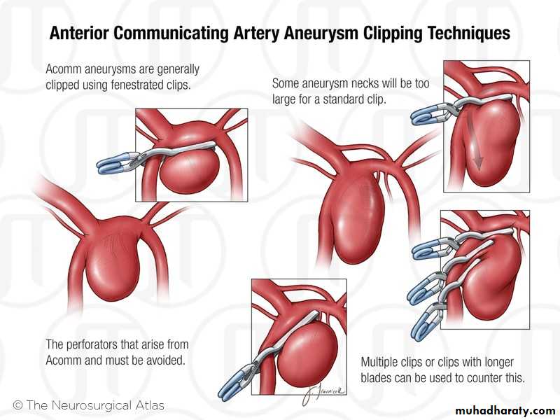 Arterial Disorders