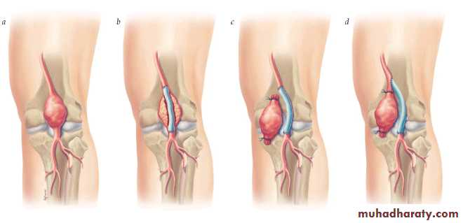 Arterial Disorders