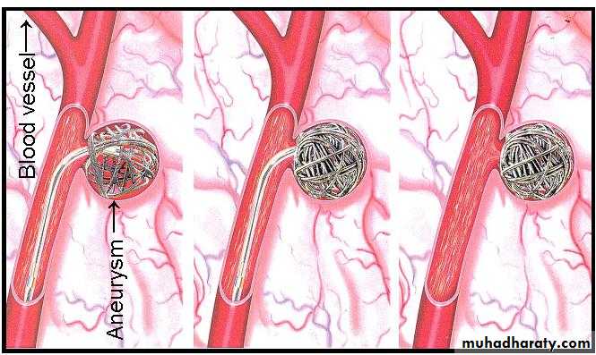 Arterial Disorders