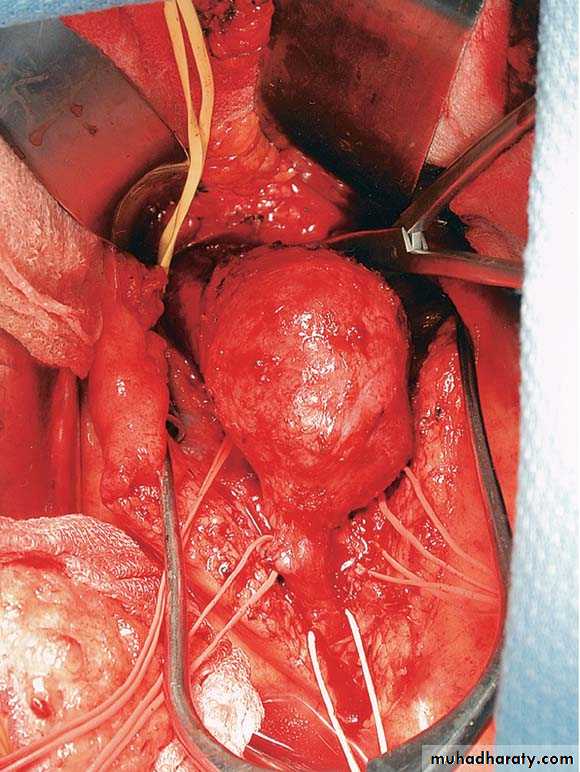 Arterial Disorders