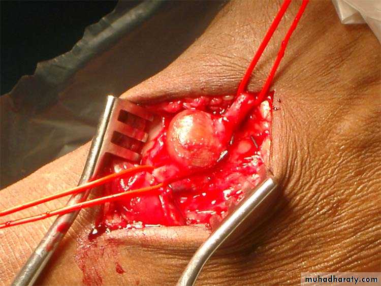 Arterial Disorders