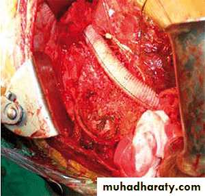 Arterial Disorders