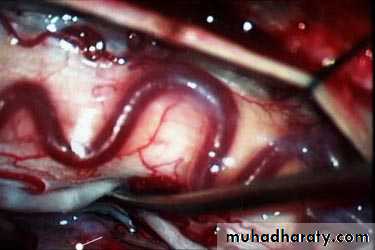 Arterial Disorders