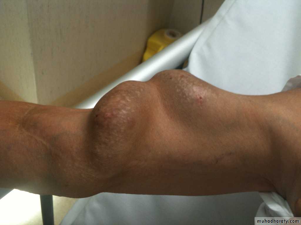 Arterial Disorders
