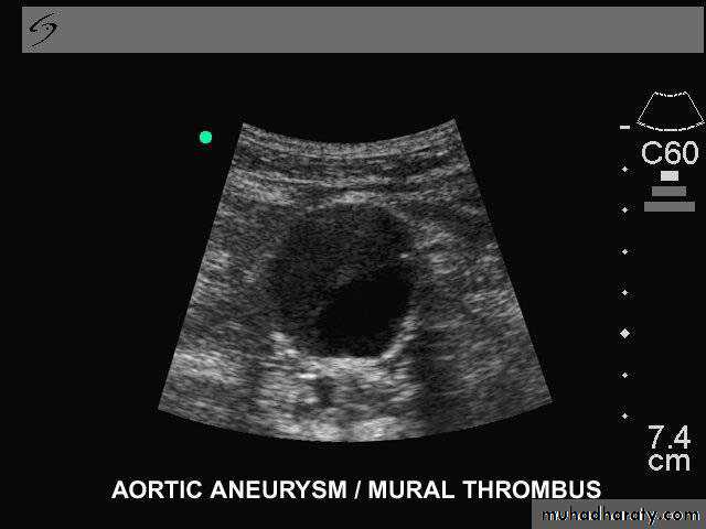 Arterial Disorders