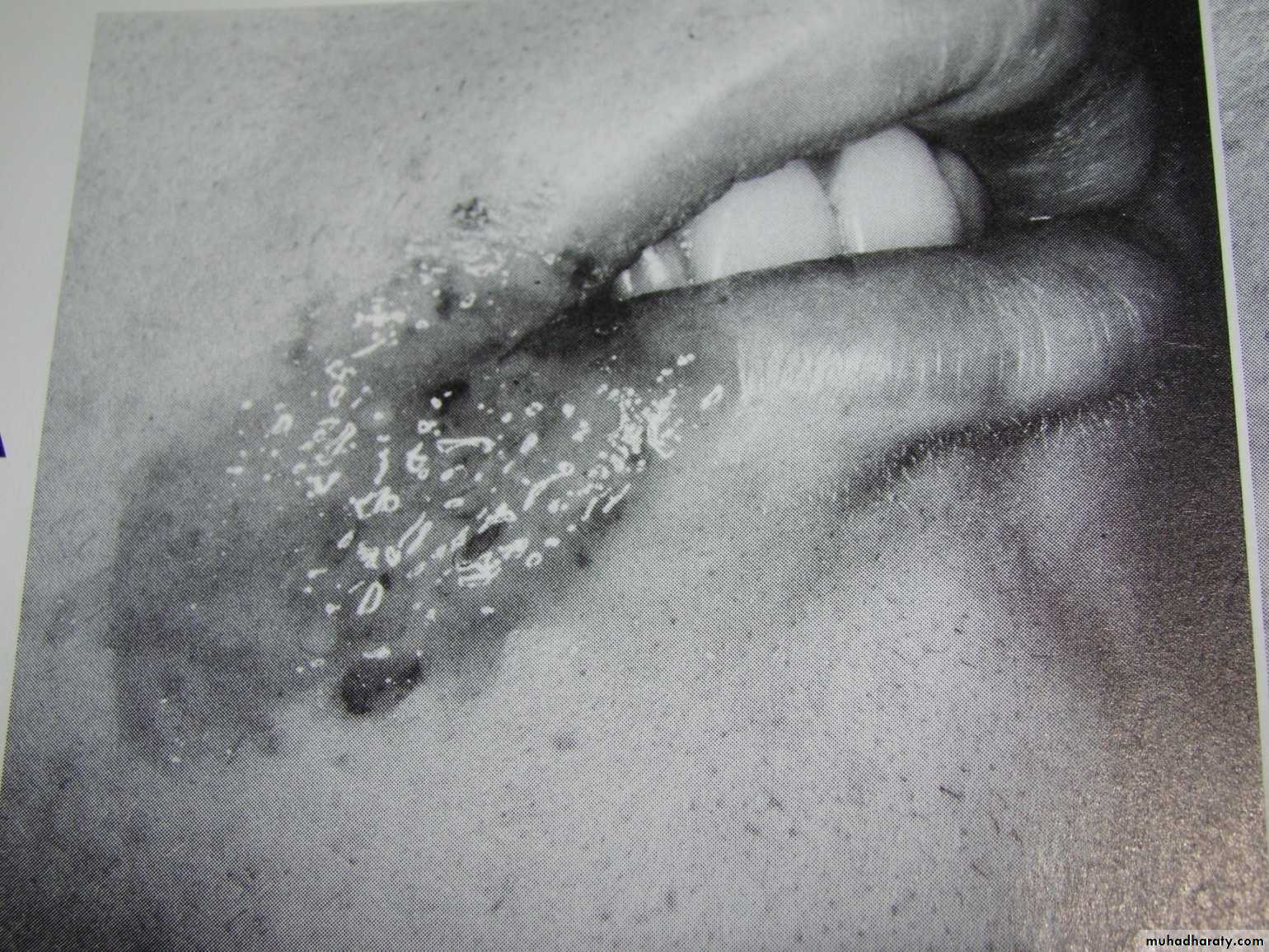 extraction