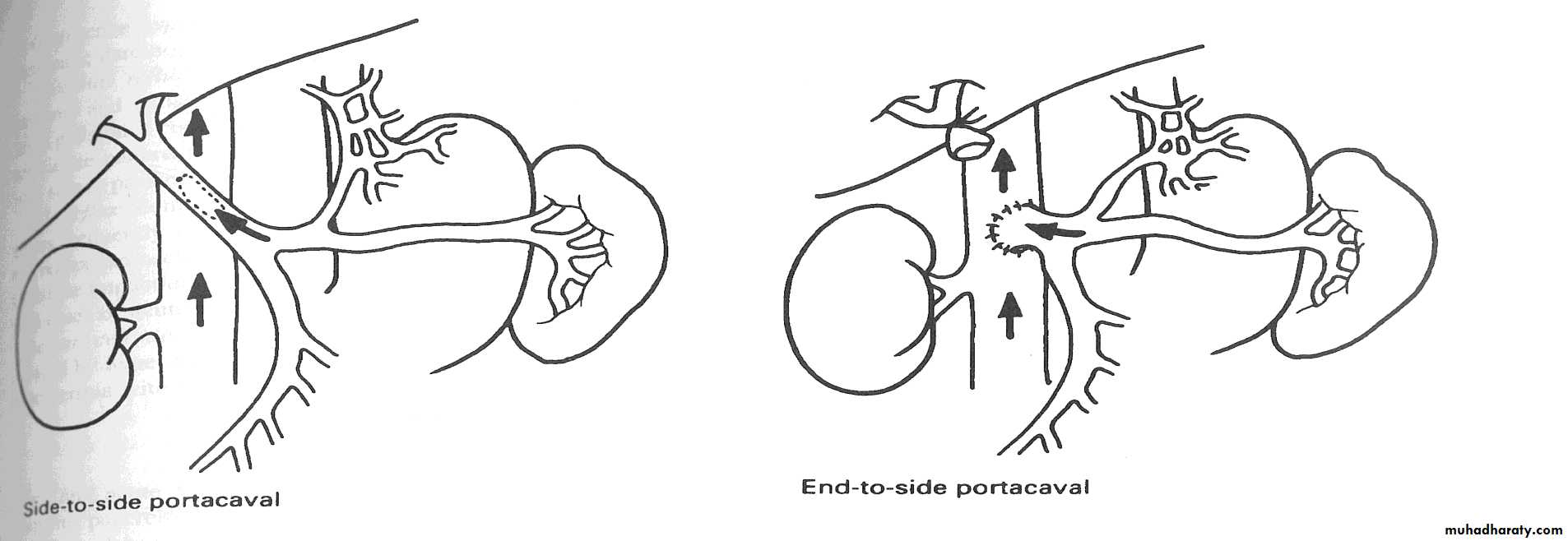 Portal Hypertension