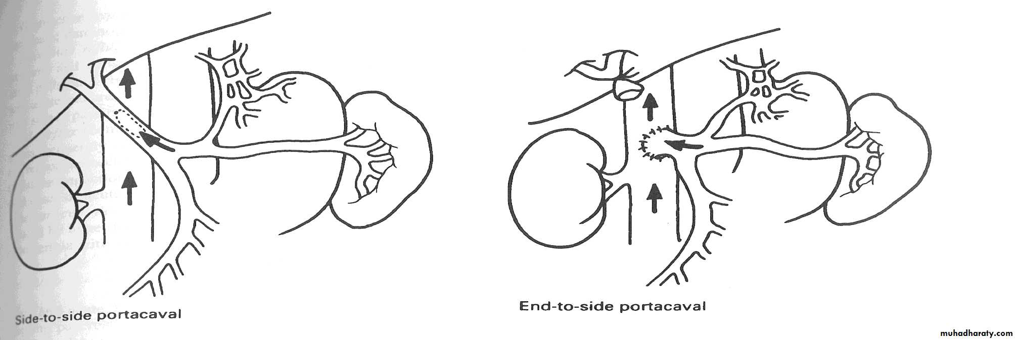 Portal Hypertension