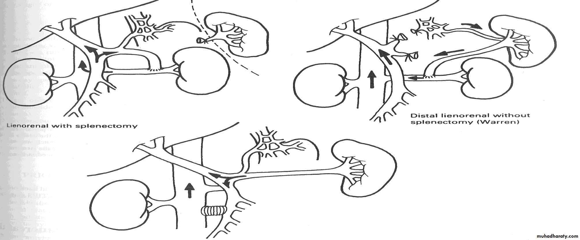 Portal Hypertension