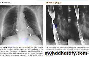 Portal Hypertension