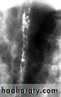 Portal Hypertension