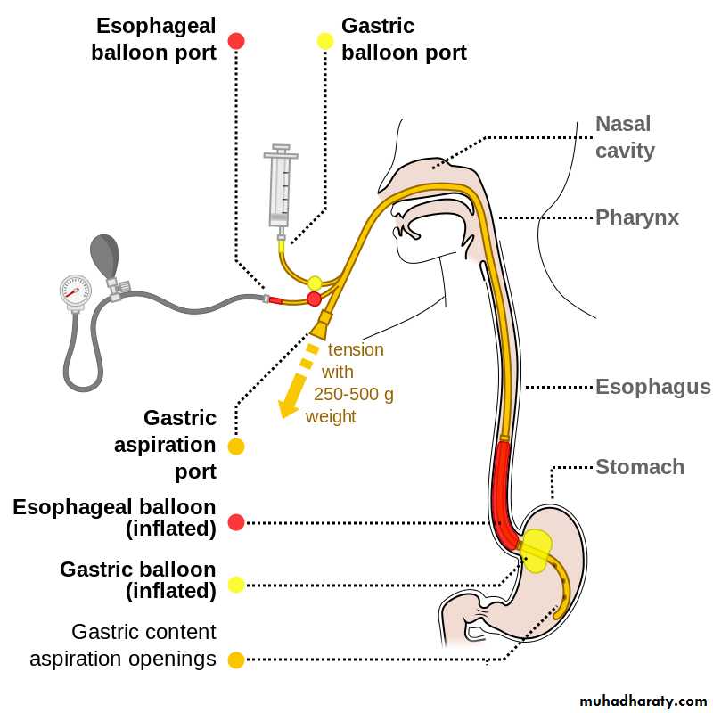 Portal Hypertension