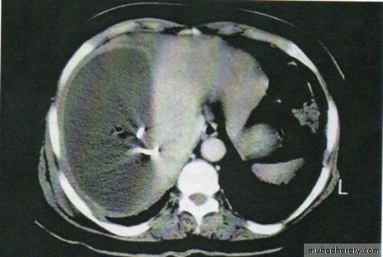 Acute Peritonitis