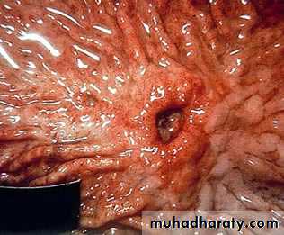 Acute Peritonitis