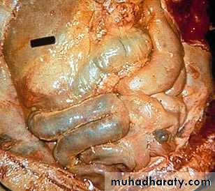 Acute Peritonitis