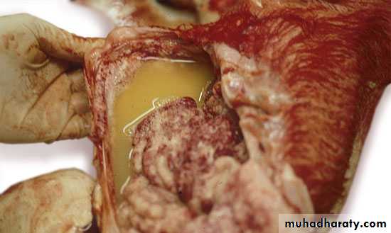 Acute Peritonitis