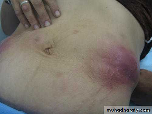 Acute Peritonitis