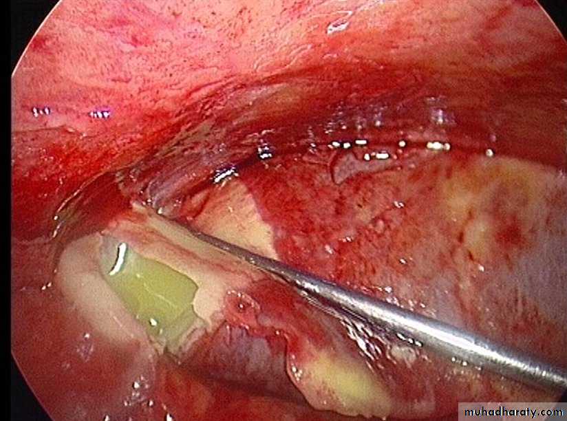 Acute Peritonitis