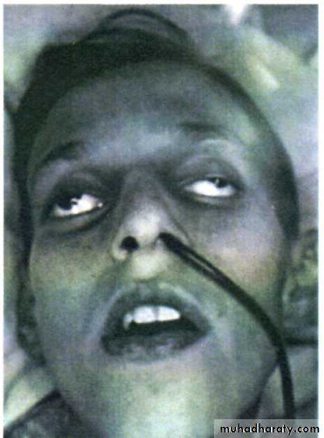 Acute Peritonitis