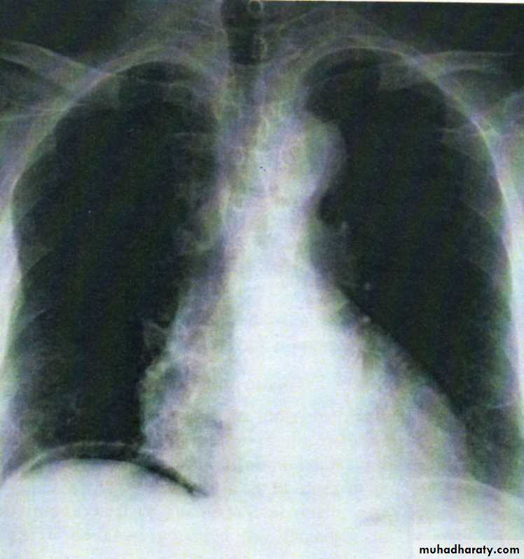 Acute Peritonitis