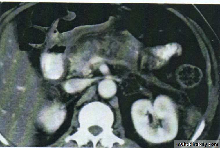 Acute Peritonitis