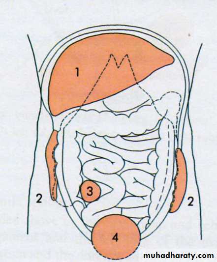 Acute Peritonitis