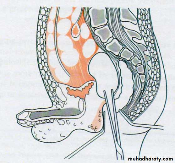Acute Peritonitis