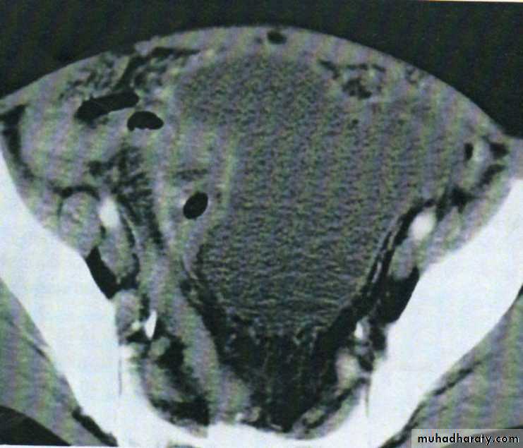 Acute Peritonitis
