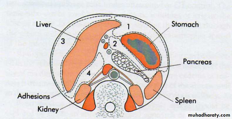 Acute Peritonitis