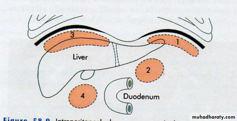 Acute Peritonitis