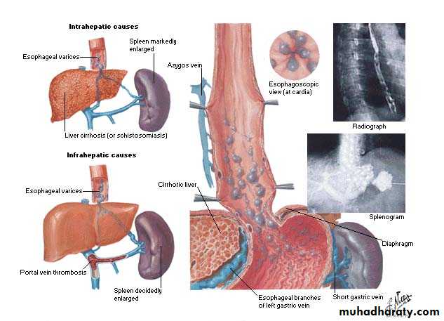 upper GI bleeding
