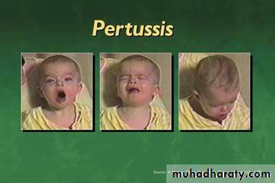Pertussis