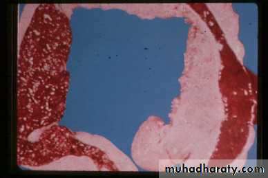 shigillosis