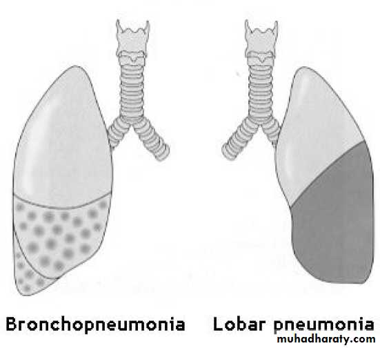 Pneumonia