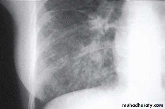 Pneumonia