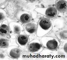 Pneumonia