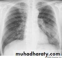 Pneumonia