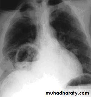 Pneumonia