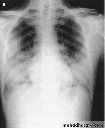 Pneumonia