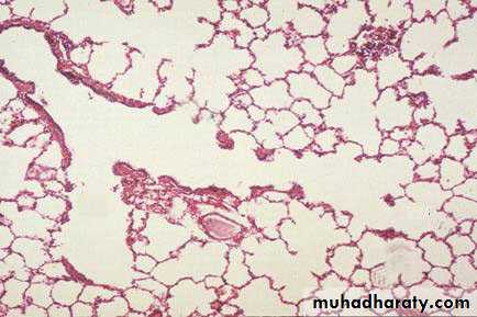 Pneumonia